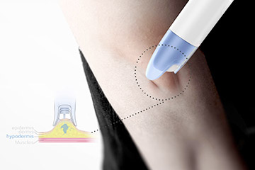 Pinching to inject